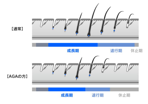 PLGAナノカプセルがAGAに効果的な理由